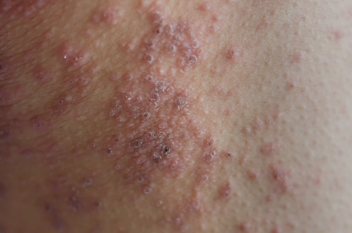D'Aura close up skin rashes caused by allergies rashes are caused by food allergies concept health care 2 1