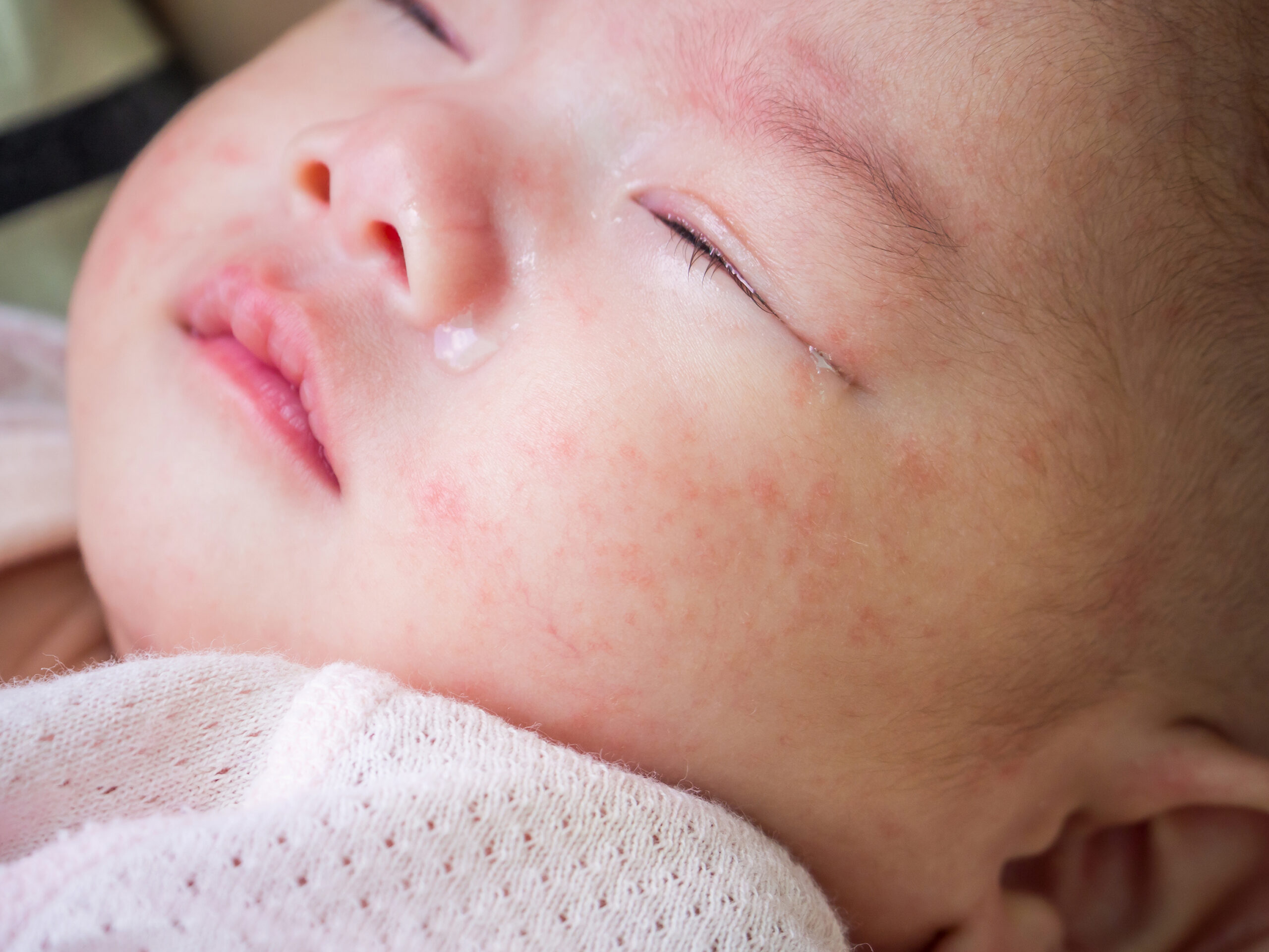 D'Aura newborn baby with dermatitis allergy face scaled